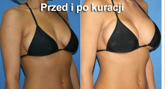 Jak naturalnie powiększyć biust - sposoby na idealne piersi