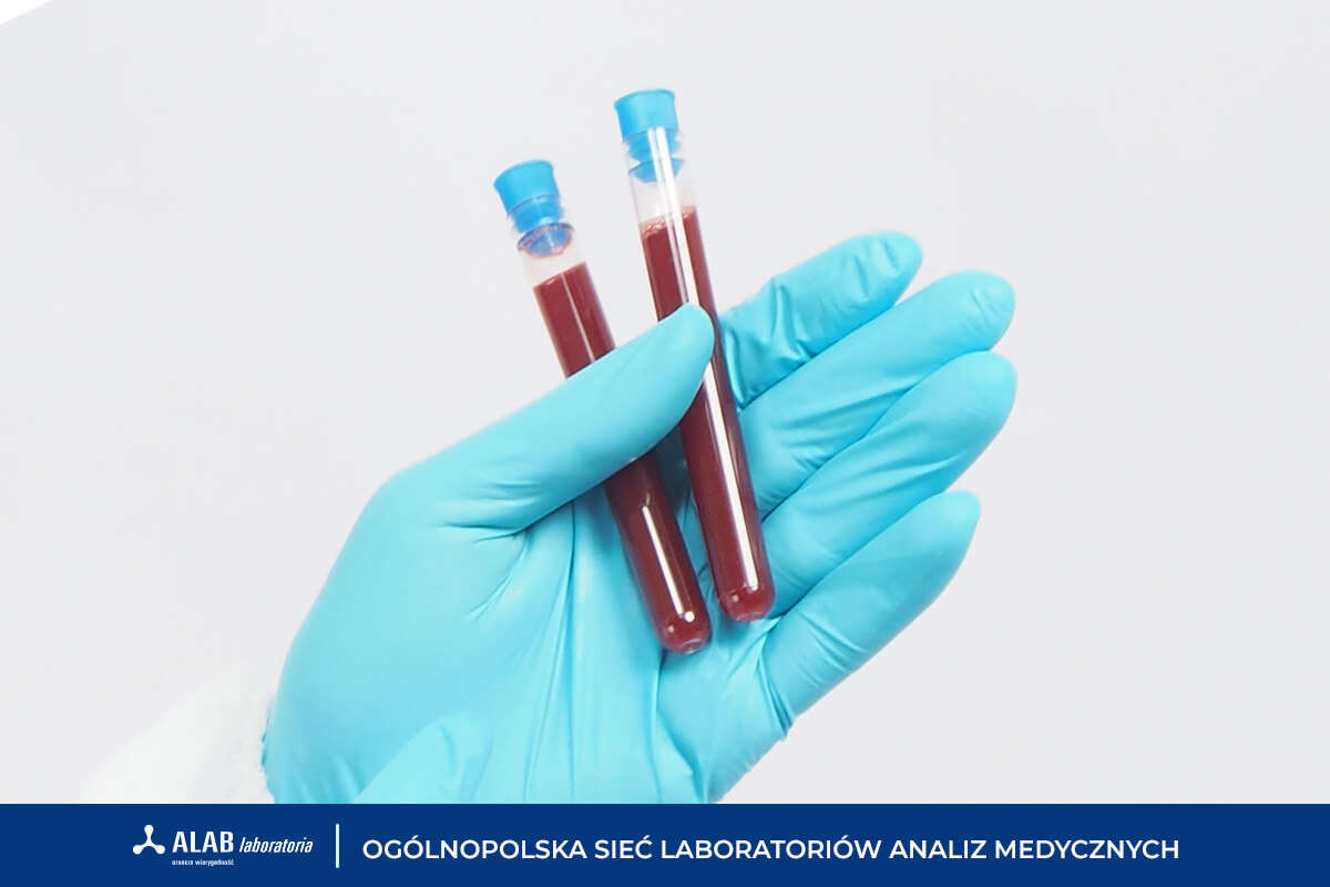 Morfologia – o czym mogą świadczyć nieprawidłowe wyniki?