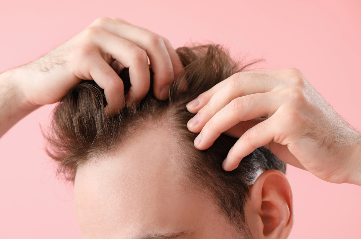 Zakola – jak się ich skutecznie pozbyć?