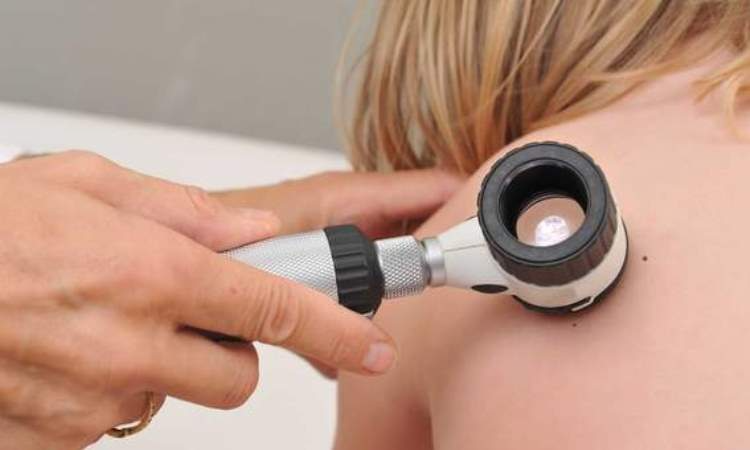 Mieszkańcy Sosnowca wykonają bezpłatne badania przesiewowe w kierunku czerniaka skóry