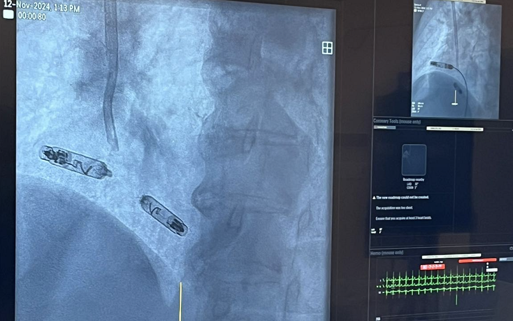 Przełom w kardiologii na Śląsku – pierwszy bezelektrodowy dwujamowy stymulator serca