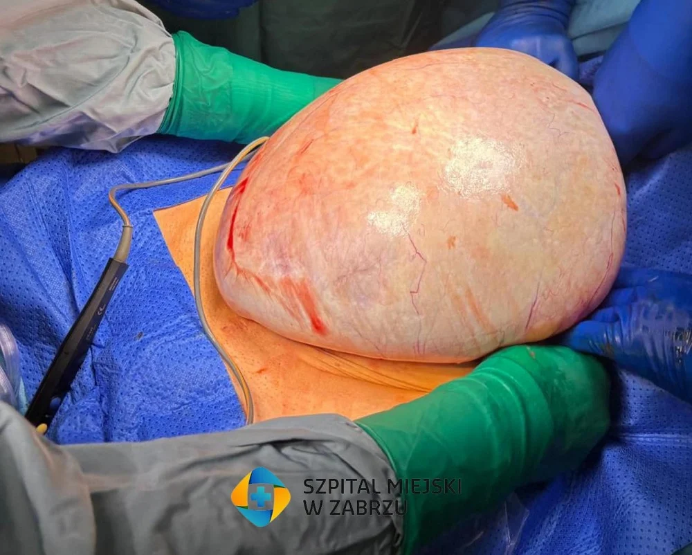 Sukces lekarzy z Zabrza! Usunęli 8-kilogramowego guza i uratowali życie pacjentki