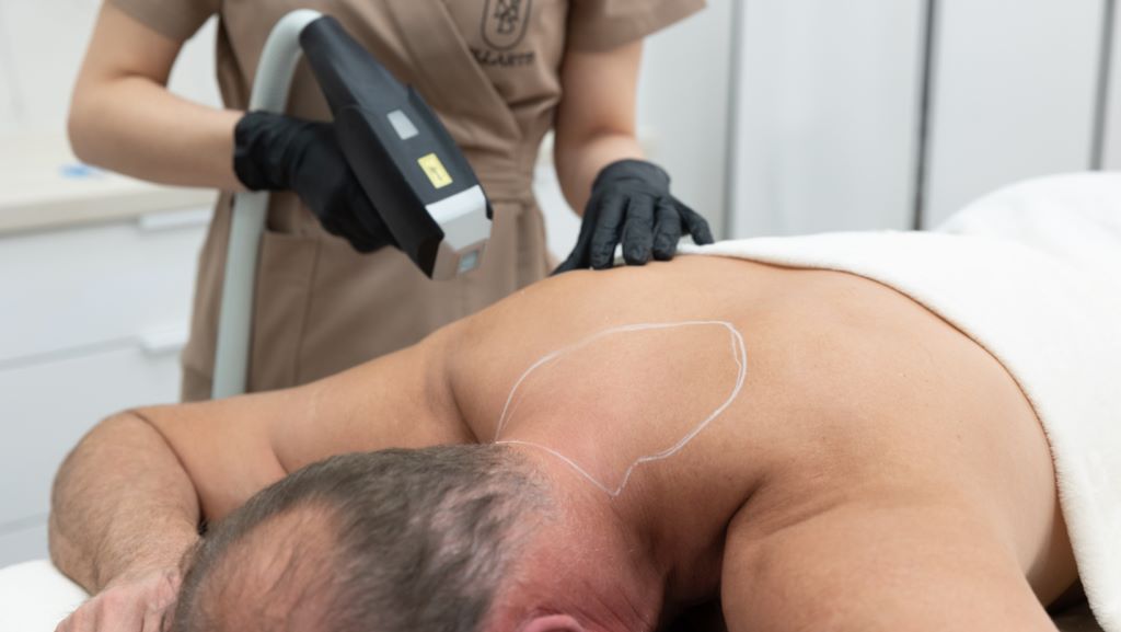 Depilacja laserowa dla mężczyzn – czy panowie decydują się na trwałe usuwanie owłosienia?