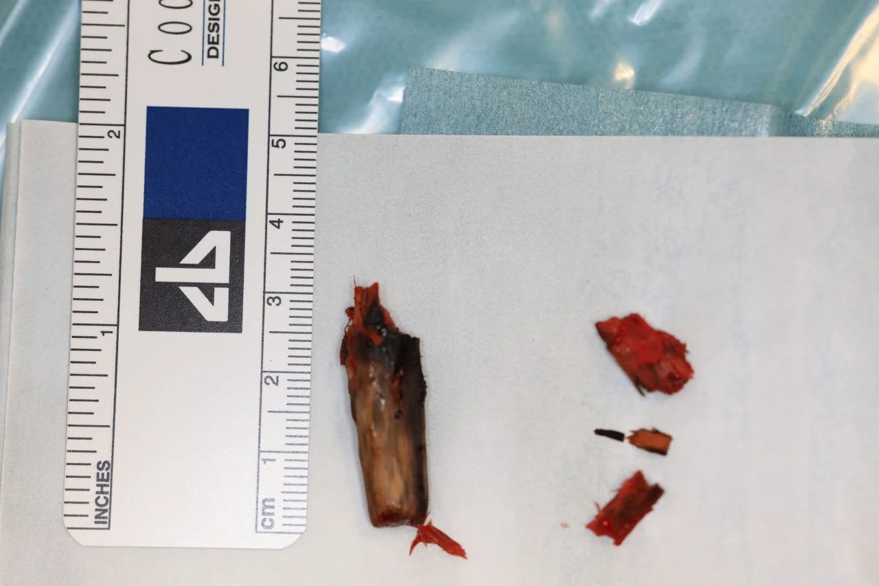 W policzku chłopca niemal 2 miesiące tkwiło drewno. Z pomocą przyszli medycy z GCZD