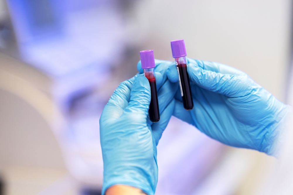 Ferrytyna – co to takiego? Jakie są objawy niedoboru ferrytyny w organizmie?