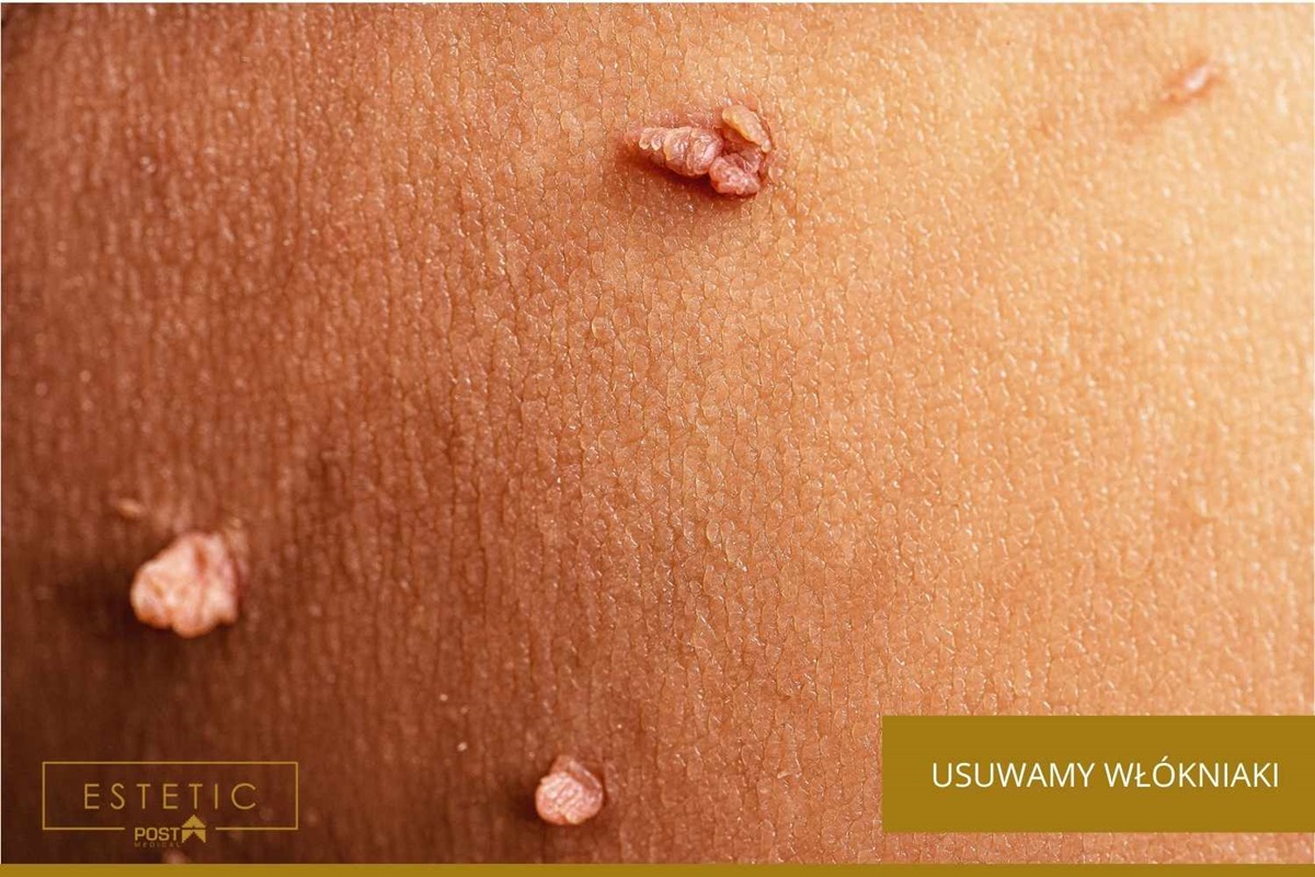 Usuwanie włókniaków i brodawek w Orzeszu? Dojedziesz do nas w 25 minut.