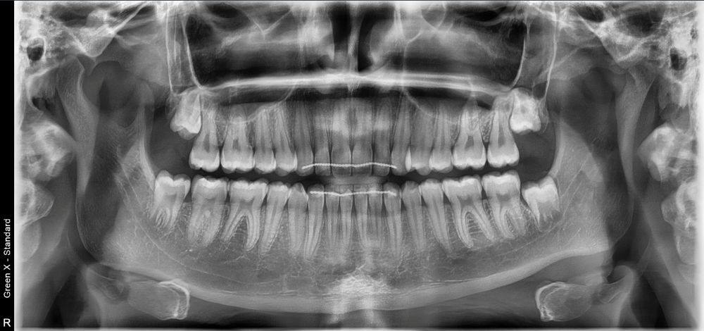 RTG stomatologiczne i tomografia CBCT od 100 zł – Świętochłowice