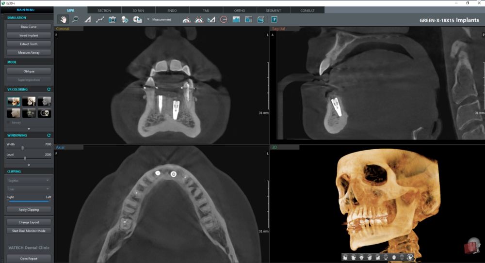 RTG stomatologiczne i tomografia CBCT od 100 zł – Świętochłowice