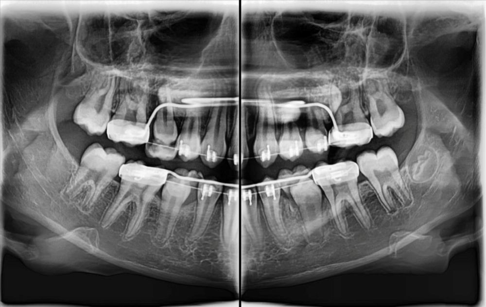 RTG stomatologiczne i tomografia CBCT od 100 zł – Świętochłowice