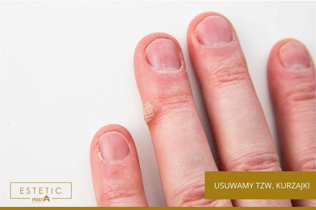 Usuwanie włókniaków i brodawek w Chorzowie? Dojedziesz do nas w 20 minut.