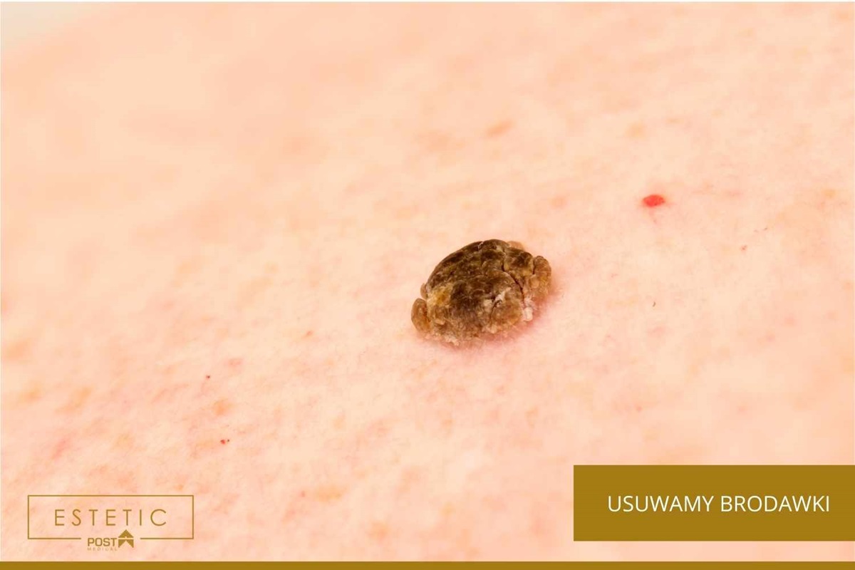 Usuwanie włókniaków i brodawek w Mikołów? Dojedziesz do nas w 20 minut.