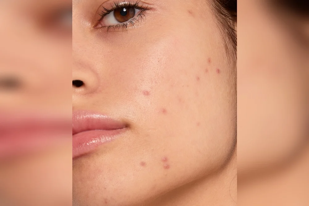 Produkty na niedoskonałości - jak dobrać je w codziennej pielęgnacji?