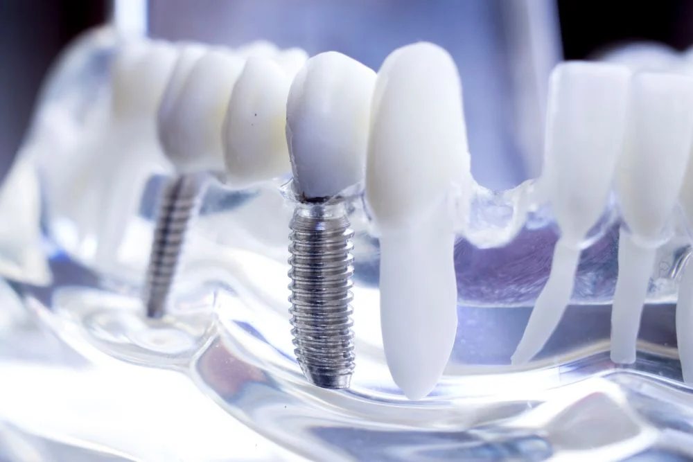 Rodzaje uzupełnień na implantach – od pojedynczego zęba po cały łuk